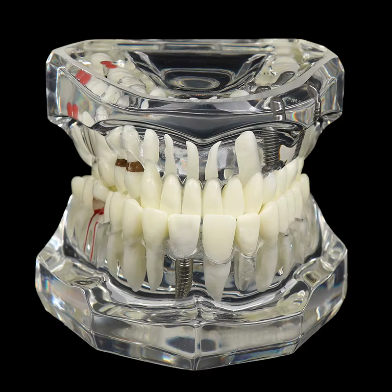 Modèle de dent de maladie avec pont dominant, dentiste pour la science médicale, étude de fuchsia de